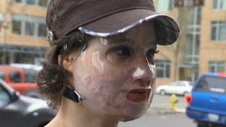 Acid Attack Hoax Bethany Storro Admits Lie Says She Suffered From Mental Illness [upl. by Drarej244]