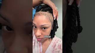 I grew my edges back using Minoxidil 5 minoxidil hairloss beforeandafter hairgrowth alopecia [upl. by Redvers]