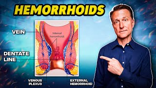 The 1 Best Remedy for Hemorrhoids  Dr Berg [upl. by Pet909]