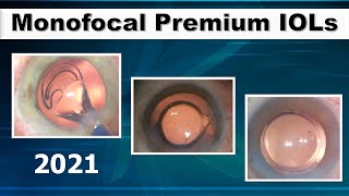 Monofocal Premium intraocular Lens Improving my Phaco [upl. by Columbine]