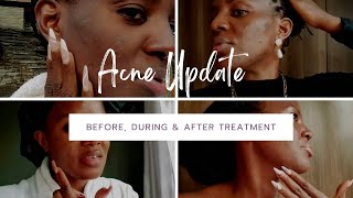 VLOG MY FULL ACNE JOURNEY  Recovery With Clabane Skin Care [upl. by Zadack60]