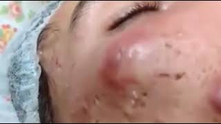 Big Acne Pus on face pop out Really hurt and terrified [upl. by Reviere725]