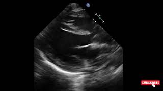 Overriding aorta in tetralogy of Fallot  Echo [upl. by Ylenaj398]