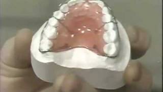 Diastema Closure  Hawley Retainer [upl. by Che]