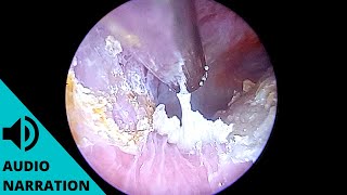 Infection causes ear to fill with dead skin acute diffuse desquamation explained [upl. by Osswald473]