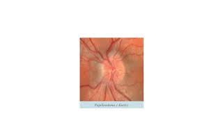 Papilloedema optic atrophy Opthal final [upl. by Rozamond]