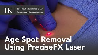 Age Spot Removal Using PreciseFX Laser by Dr Hooman Khorasani [upl. by Rombert]