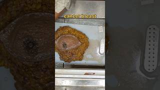 Carcinoma breast cancer breast specimen [upl. by Nymassej]