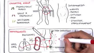 Septic Arthritis  Overview causes pathophysiology treatment [upl. by Adis]