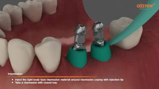 OSSTEM TSIII Fixture Placement Impression taking Pick up and Transfer Impression Copings [upl. by Corenda313]