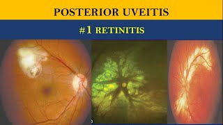 POSTERIOR UVEITIS  retinitis vs choroiditis [upl. by Laraine795]