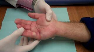 Xiaflex Injection  Manipulation for Dupuytrens Contracture [upl. by Surovy]