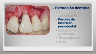 RTR Preservación del Reborde Alveolar Post Extracción [upl. by Ahsenik663]