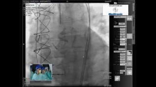 TAVI Corevalve quotValve in Valvequot de Medtronic [upl. by Ahern311]