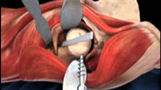 Femoral Head Osteotomy Animation  Direct Anterior Total Hip Replacement [upl. by Bunny2]