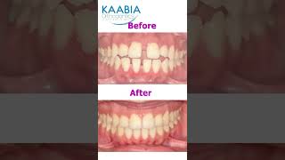 Bimaxillary protrusion  open bite and diastema [upl. by Caro]