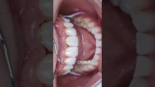 Veneers vs Crown  Front Teeth  Aesthetic  Dentistry [upl. by Onra]