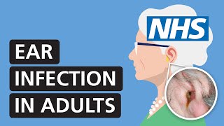 Ear infection in adults symptoms treatment and pain relief  NHS [upl. by Checani685]