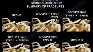 Clavicle Fractures Classification  Everything You Need To Know  Dr Nabil Ebraheim [upl. by Goldia]