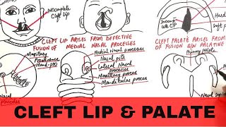 Cleft Lip and Palate  Pathophysiology Causes amp Management [upl. by Larcher]