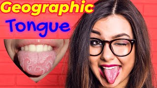 Benign Migratory Glossitis😛  Geographic👅 Tongue Homeopathic Treatment  Mapped Tongue 😜 [upl. by Eynenihc]