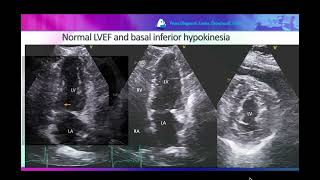 Normal LVEF and reduced GLS in a patient with triple vessel CAD [upl. by Eirek792]