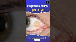 Pinguecula Yellow Spot in Eye Pinguecula eye testpaperlive [upl. by Natanoy]