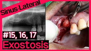 Online Surgery Sinus graft using LAS KIT amp Excision of bony exostosis [upl. by Assenaj]