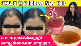 OMG😱 Baldness Hair Growth Treatment  frontal baldness hair regrowth in tamil  Jegathees meena [upl. by Eisyak482]