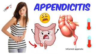 Appendicitis  The only video you will need [upl. by Nazarius]