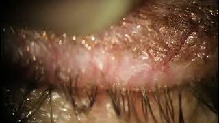 Extracting Dead Demodex Mite Carcasses from Eyelid [upl. by Heyes]