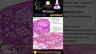 Rhinoscleroma  Rhinosporidiosis  rhinoscleroma rhinosporidiosis pathlink [upl. by Orual880]