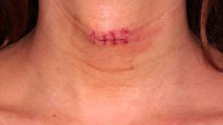 Larynx Adams Apple Reduction Surgery Before  After  Kehlkopf verkleinerungs Operation [upl. by Iadahs]