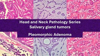 Pleomorphic Adenoma 101  highyield educational video [upl. by Severson]