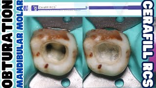 Cerafill RCS  Bioceramic Root Canal Filling amp Sealing Material  Obturation in Mandibular Molar [upl. by Wescott]