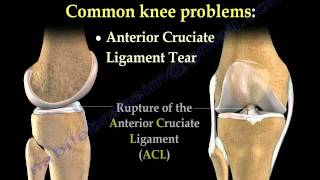 Knee Pain  common causes Everything You Need To Know  Dr Nabil Ebraheim [upl. by Swope]