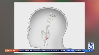 Musk’s Neuralink implants brain chip in 1st human [upl. by Mcloughlin539]