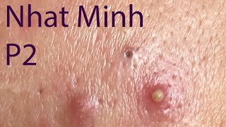 Acne Treatment Huong Da Nang 029  Treatment for Nhat Minh Part 2 [upl. by Yorke]