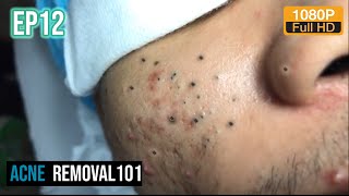 Cystic Acne Extraction 30mn  Blackheads Removal by ACNEREMOVAL101 [upl. by Duwe]