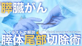 膵臓癌に対する手術「膵体尾部切除術 distal pancreatectomy」の術式と看護についてわかりやすく解説！ [upl. by Nnaaras]