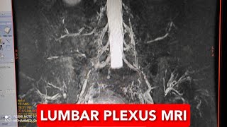 Lumbar Plexus MRI [upl. by Shellans]