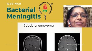 Bacterial Meningitis IAP Thiruvananthapuram Pediatric Webinar [upl. by Noll832]