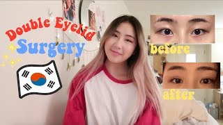 ALL ABOUT MY DOUBLE EYELID SURGERY nonincisional [upl. by Zetes995]