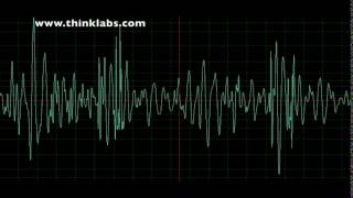 Atrial Septal Defect [upl. by Soisinoid]