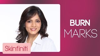 How To Treat Burn Marks  Skincare  Skinfiniti With DrJaishree Sharad [upl. by Nerred332]