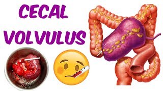 A Cecal Volvulus [upl. by Smart]