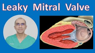 Leaky Mitral Valve  Mitral Valve Regurgitation [upl. by Barbarese]