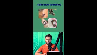 Skin cancer awareness छाला को ध्यान दिनु पर्ने परिबर्तन [upl. by Ham]