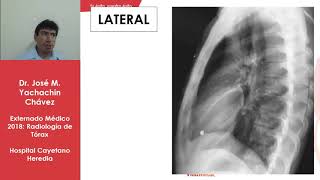 RADIOLOGIA DE TORAX [upl. by Nidnal]