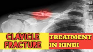 Clavicle Fracture Treatment  IN HINDIWhat is the Treatment and Recovery from a clavicle fracture [upl. by Saphra277]